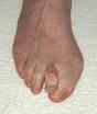 Hammer-toe-picture.jpg