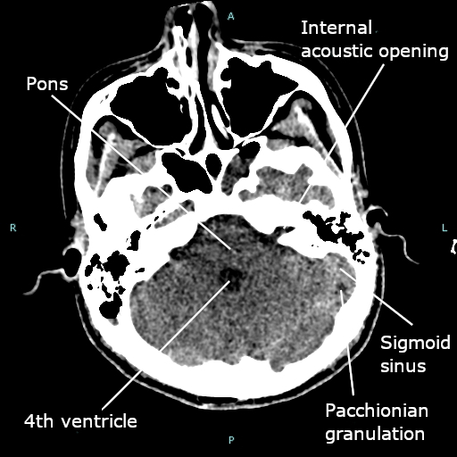 File:CT scan showing Pacchionian granulation at left sigmoid sinus.jpg