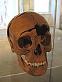 Lubanja obezglavljene žene stare između 20 i 30 godina iz 3. stoljeća pronađena u bunaru rimske vile u Njemačkoj (Regensburg-Harting). Rezni znakovi kod desne očne duplje pokazuju da je bila skalpirana.