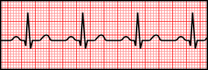 Normal Sinus Rhythm.svg