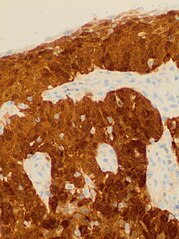 Cervical squamous cell carcinoma generally shows diffuse staining of both nuclei and cytoplasm on p16 immuno- histochemistry (except verrucous variant).[74]