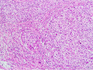 Invasive squamous cell carcinoma of the cervix is characterized by infiltration as irregular anastomosing nests or single cells.[73] This case is poorly differentiated. H&E stain.