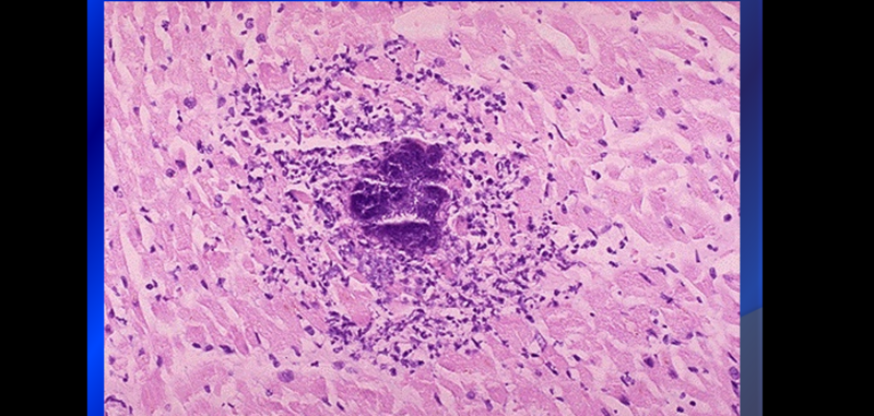 File:Miocarditis.png