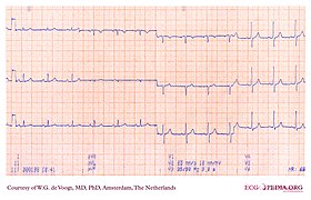 DVA0346 (CardioNetworks ECGpedia).jpg