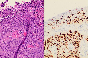 Invasive cervical squamous cell carcinoma on H&E histopathology and Ki-67 immunohistochemistry. The latter correlates well with the degree and level of dysplasia.[75]