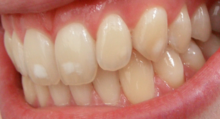 Dental fluorosis (mild).png