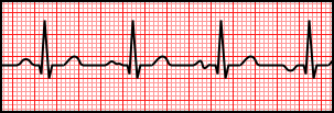 Wandering Atrial Pacemaker.svg