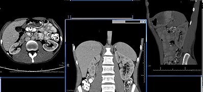 CT-skenirana slika trbuha sa položajem bubrega. Lijevi presjek u gornjem dijelu trbuha prikazuje jetru na lijevoj strani skeniranja (desna strana tijela). Centar: presjek koji prikazuje bubrege ispod jetre i slezenu. Desno: dalji presjek kroz lijevi bubreg