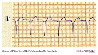 DVA0330 (CardioNetworks ECGpedia).jpg