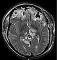 RMN postoperatoria de un paciente con traumatismo craneoencefálico y herniación cerebral resultante.