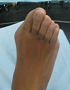 Hallux.jpg