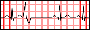 Premature Ventricular Complex.svg