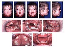 Patient with Apert (ACS Type I) syndrome