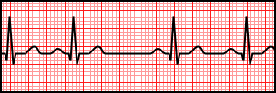 Sinus Arrhythmia.svg