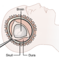 Decompressive Craniectomy