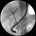 Fluoroscopic image taken during endoscopic retrograde cholangiopancreatography (ERCP). Multiple gallstones are present in the gallbladder and cystic duct. The common bile duct and pancreatic duct appear to be unobstructed.