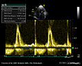 Pulsed-wave Doppler signal of mitral inflow showing restrictive pattern and diastloc dysfunction Restrictive cardiomyopathy
