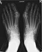 Projectional radiograph of bunion.jpg