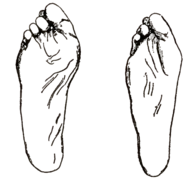 Soldiersfootmili00munsrich Fig46 Deformities of feet resulting from bad shoes.png