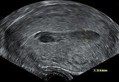 Hematometra