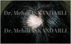 Başında ocaqlı alopesiya olan xəstə