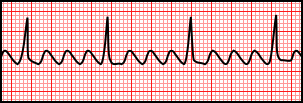 Atrial Flutter.svg