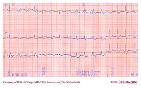 DVA0304 (CardioNetworks ECGpedia).jpg