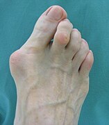 Hallux valgus und Krallenzehe II (präop.).jpg