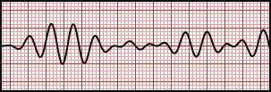 Torsades de Pointes (polymorphic VT).svg