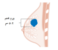 مرحلة T2 في سرطان الثدي