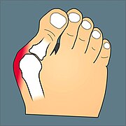 Hallux valgus.jpg