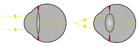 Пример различной рефракции глаз