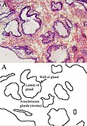 Microscopic glands of the prostate