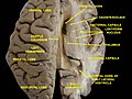 Human brain dissection, showing the thalamus.