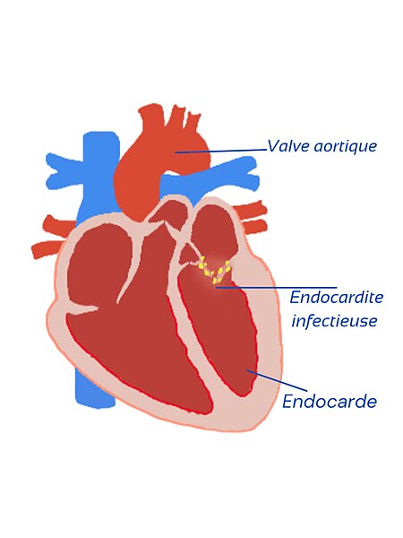 File:Endocardite infectieuse.jpg