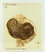 Thyroide Goitre nodulaire simple (vue antérieure) 55-o.apatho-441a-thyroide.jpg