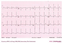 DVA0240 (CardioNetworks ECGpedia).jpg