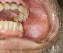 Leukoplakia02-04-06.jpg