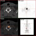 Natriumfluorid-PET/CT desselben Patienten: Die osteolytische Knochenmetastase in der Halswirbelsäule zeigt einen extremen Uptake und ist klar erkennbar. Die beiden weiteren Knochenmetastasen in der Lendenwirbelsäule stellen sich in der PET/CT-Aufnahme ebenfalls sehr gut dar.