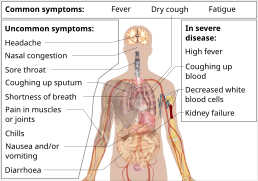 Symptoms of coronavirus disease 2019 2.0.svg