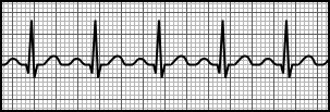 Sinus Tachycardia.svg