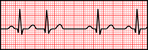 Premature Junctional Complex.svg