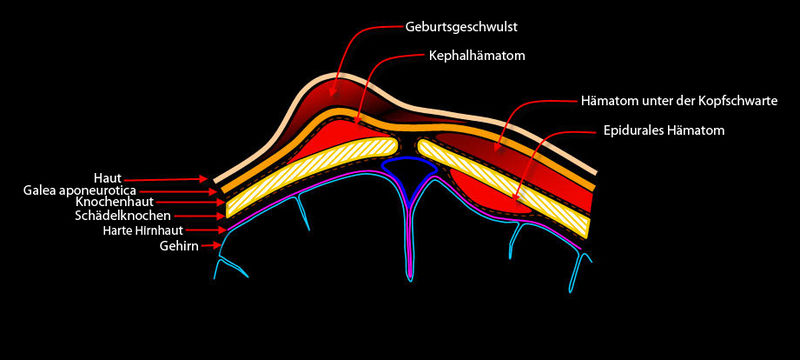 File:Scalp hematomas-2.jpg