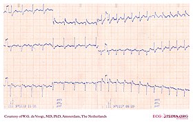 DVA0342 (CardioNetworks ECGpedia).jpg