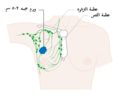 مرحلة 3B في سرطان الثدي