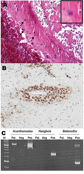 File:Acanthamoeba pathology.jpg