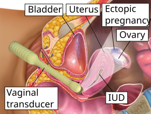 வேற்றிடச்சூல் ஒன்றின் மீயொலி வரைவு (Transvaginal ultrasonography)