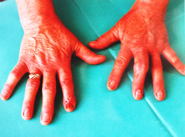 Description de l'image Hands post uric arthritis treatment.png.