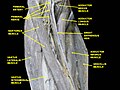 Femoral nerve.Deep dissection.