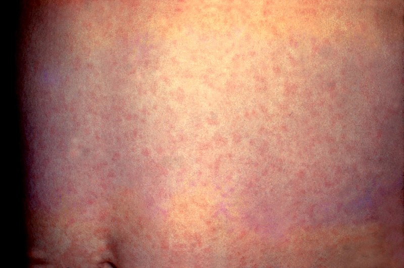 File:Rubella.jpg